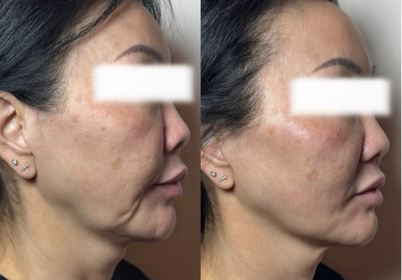 Before and after result from the Beauty Guru reference gallery, example 3