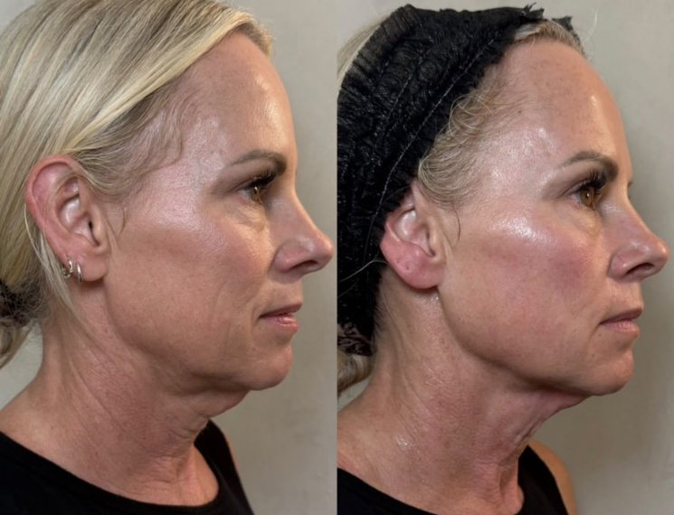 Before and after result from the Beauty Guru reference gallery, example 4